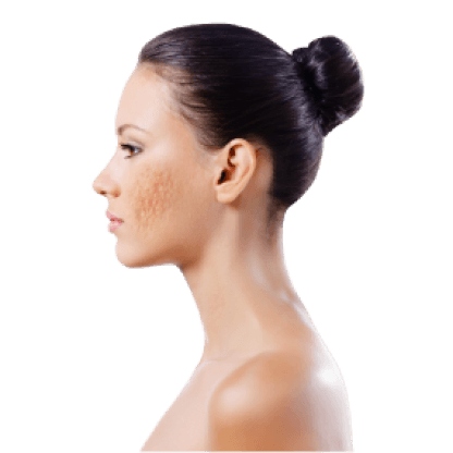 Acne Scar Treatment