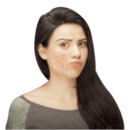 Pimples Treatment