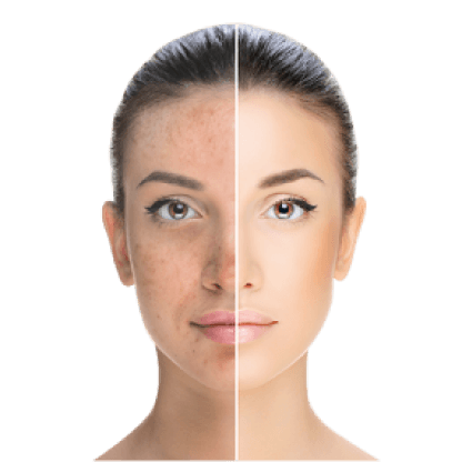 Pigmentation Treatment